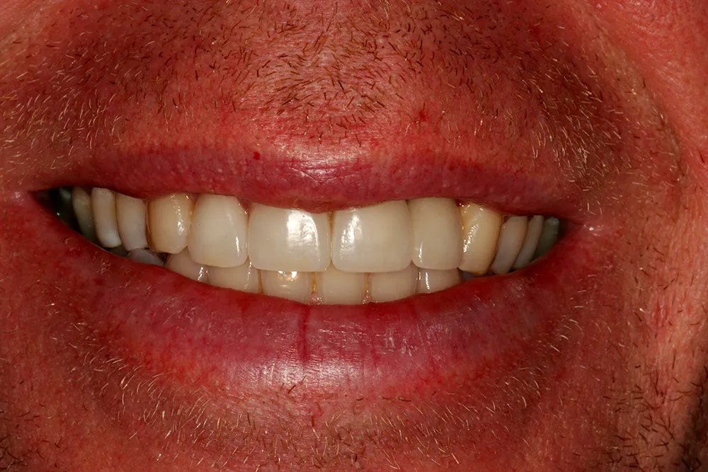 Smile gallery case 1
