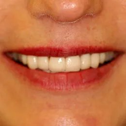 Smile gallery case 4